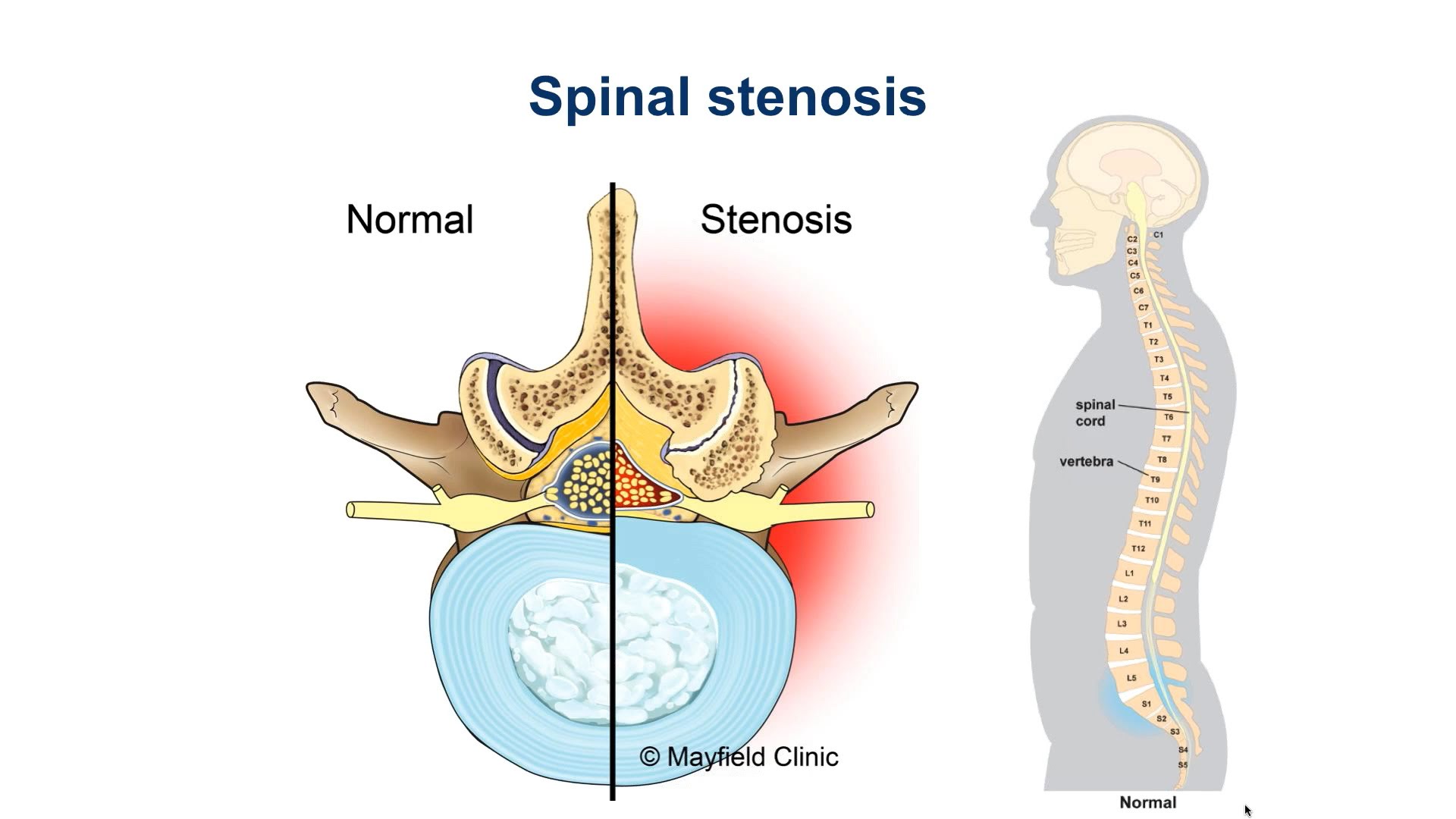 What Is Lumbar Spinal Stenosis