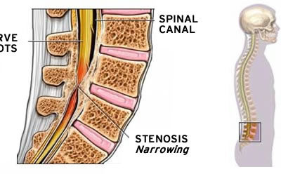 What is Spinal Stenosis and What Causes It?