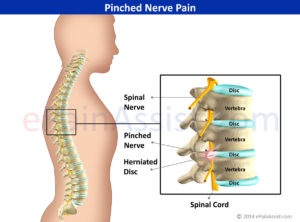 Pinched-Nerve-Pain-san-diego