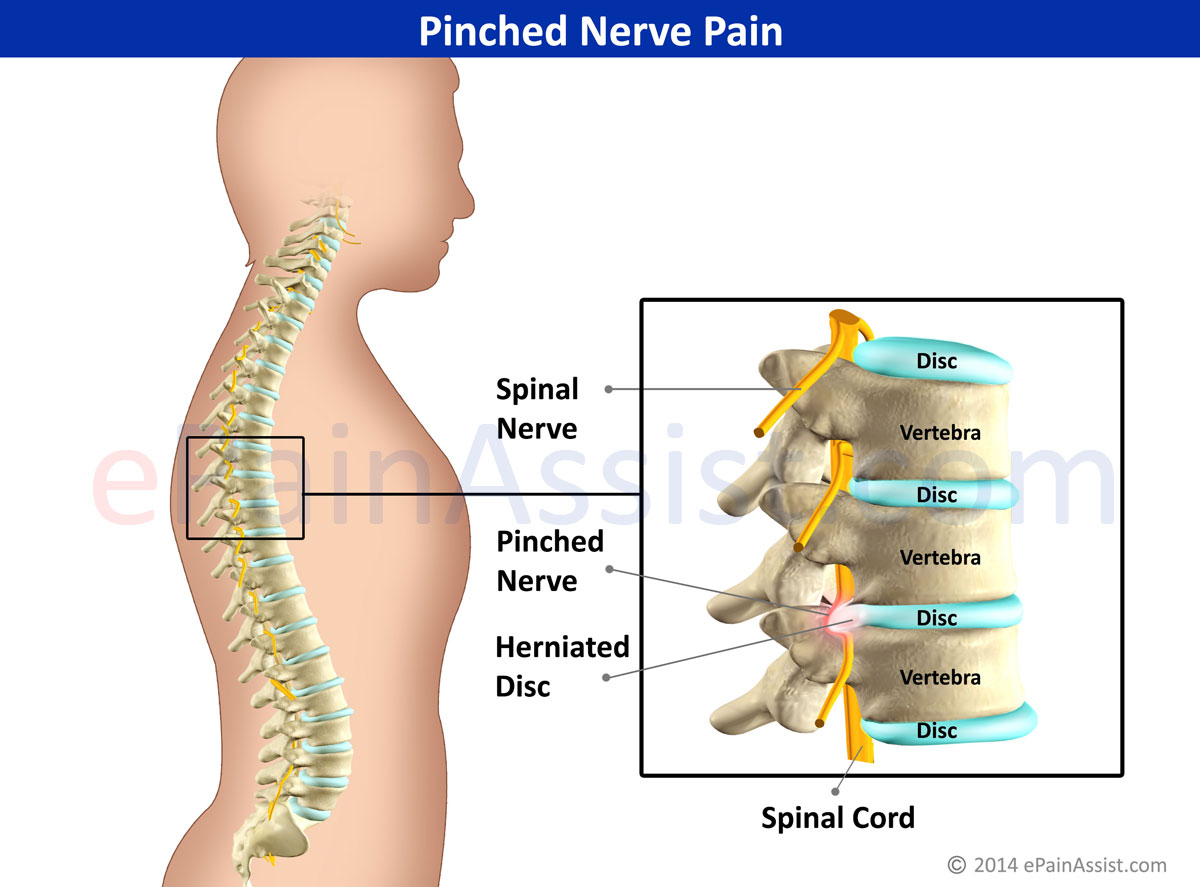 Pinched Nerve in Lower Back: Causes, Symptoms, and Treatments