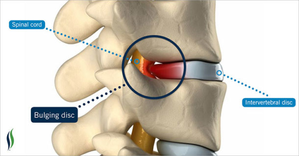 Bulging-disc–3d-render | San Diego Chiropractor