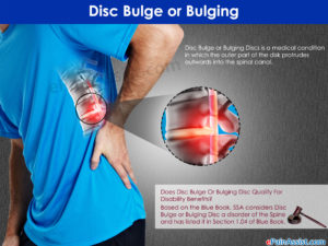 Buldging Disc | Symptoms & Causes of a Buldging Disc