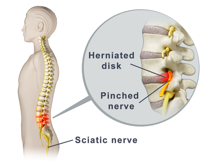 10-simple-pinched-nerve-exercises-losethebackpain-com