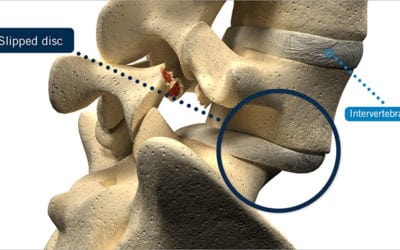 Slipped Disc | Treatment, Causes & Symptoms