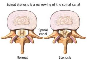 spinal_stenosis_1